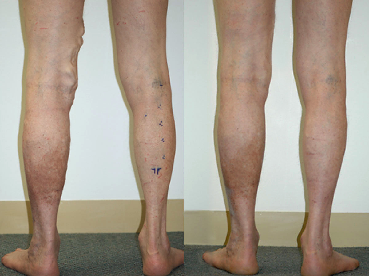 Vascular Health Group Endovenous Laser Therapy